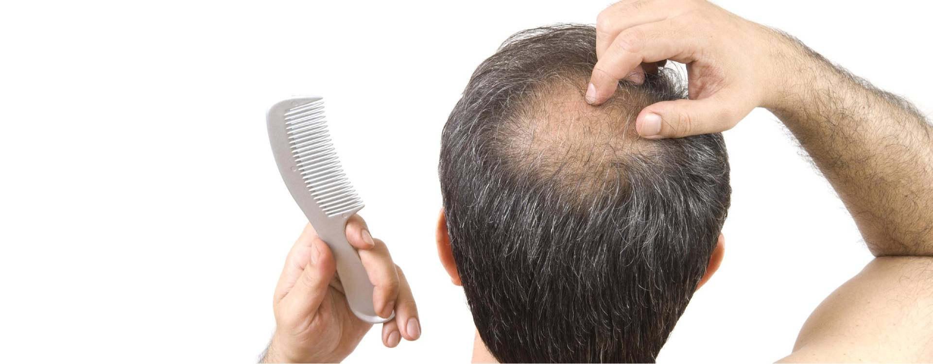 Haarausfall Tonsur Haartransplantation