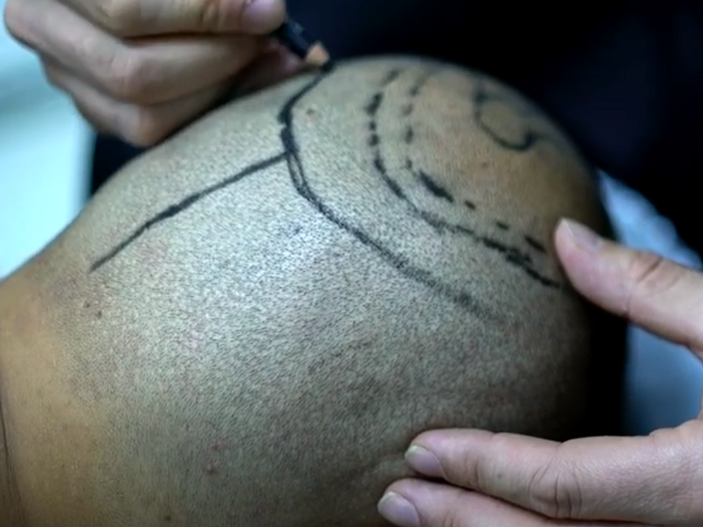 Haartransplantation Planung