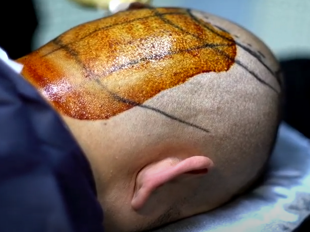 Haartransplantation Extraktion der Haare