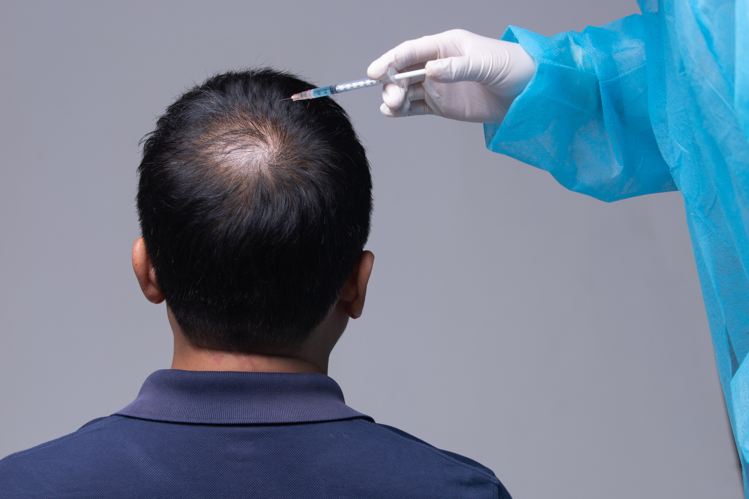 PRP-Behandlung und Mesotherapie bei Männern