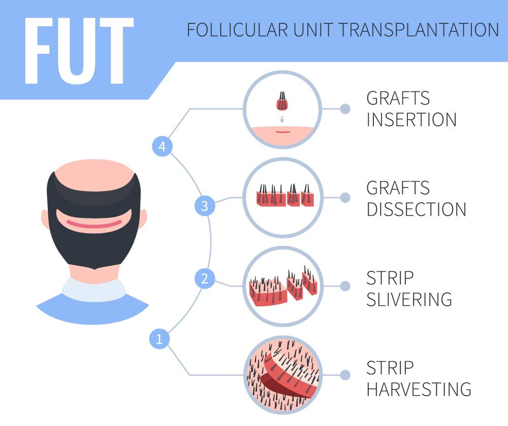 FUT Follicular Unit Transplantation Streifenmethode