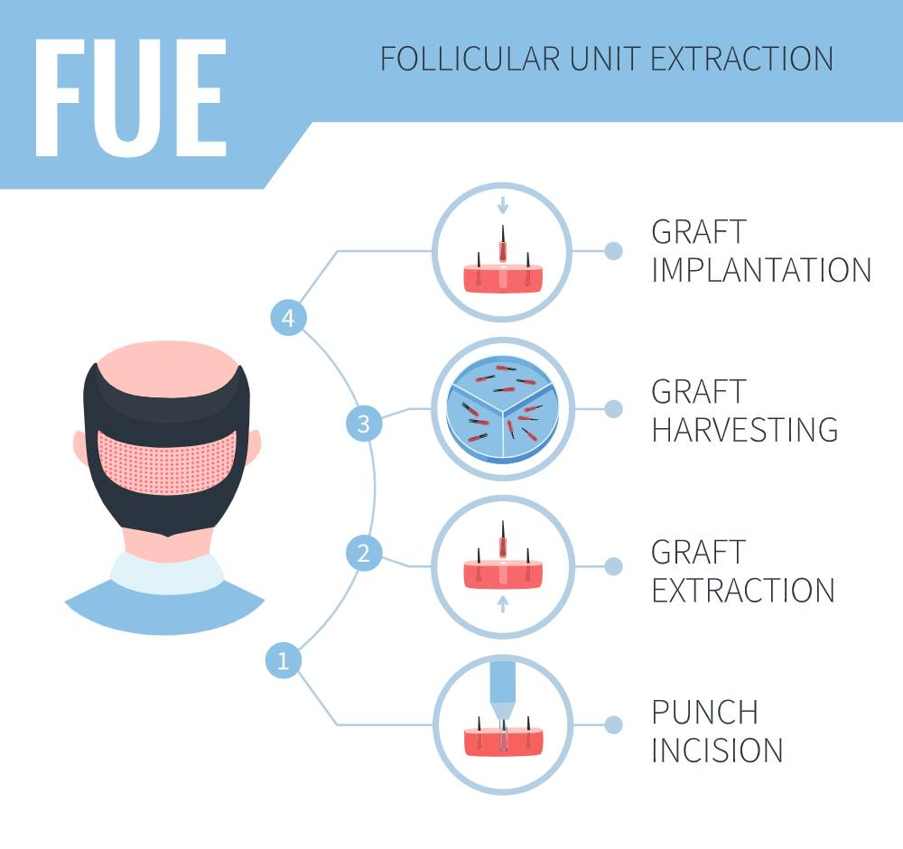 FUE - Methode