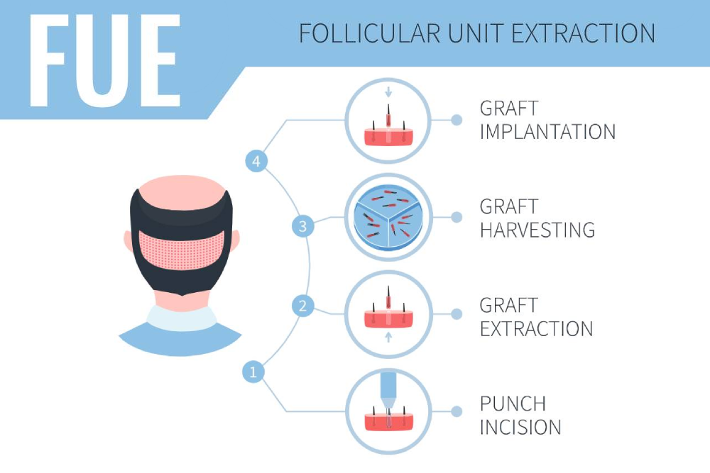 FUE - Methode