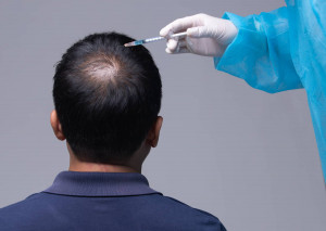 PRP-Methode zur Behandlung von Haarausfall bei Männern