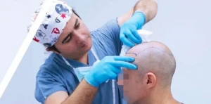 Dr. Resul Yaman Haartransplantation Türkei Istanbul